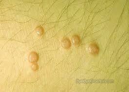 Among the 150 strains of hpv, about 10 cause cutaneous (skin) warts, including common, plantar, and flat warts (see common types of skin warts, below). Genital Wart Vs Ingrown Hair Galleryhip Com The Hippest Galleries Molluscum Contagiosum Home Remedy