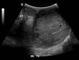 We did not find results for: Gestational Trophoblastic Neoplasia Ultrasound Wikidoc