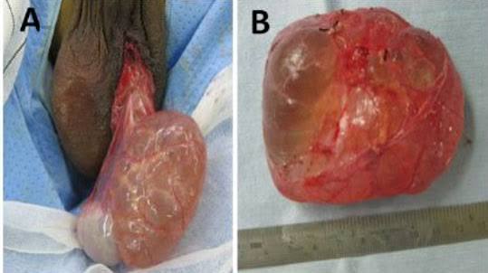 Spermatocèle multiloculaire géante chez un patient présentant un gonflement scrotal gauche - Journal of Case Reports and Images in Urology