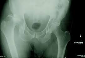 Image result for Hip Dislocation
