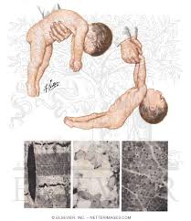 Image result for Floppy Infant