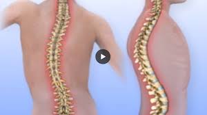 It is the surface of the body opposite from the chest and the abdomen. Scoliosis Treatment Options For Kids And Adults Hss