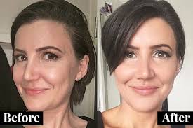 This Is What Happens In A Liquid Facelift She Said Liquid Facelift Facial Fillers Under Eye Fillers