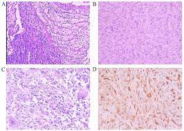.mesothelioma and spindle cell/pleomorphic (sarcomatoid) carcinomas of the lung: Multiple Intracranial Metastases From Postoperative Giant Sarcomatoid Malignant Pleural Mesothelioma A Case Report And Literature Review