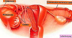 In the acute course of the disease treatment of adnexitis. Adnexitis Causes Symptoms Diagnosis Treatment Health