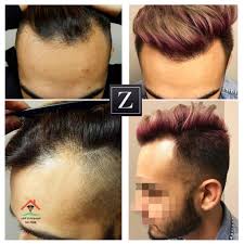 زراعة الشعر في مصر تعرف علي افضل وارخص مكان موسوعة دار الطب