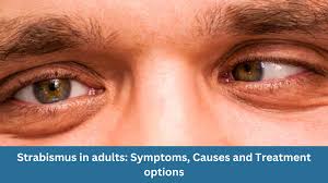 Image result for Strabismus