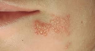 Herpes virus and newborn babies: Herpes Simplex Dermatologist In Sandy Springs Ga Roswell Ga Alpharetta Ga Cumming Ga