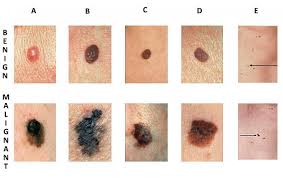 Abcde Skin Cancer Chart 636 Zona Med Spa