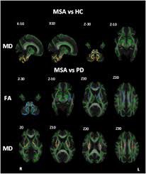 Check spelling or type a new query. Diffusion Tensor Imaging Of Parkinson S Disease Multiple System Atrophy And Progressive Supranuclear Palsy A Tract Based Spatial Statistics Study