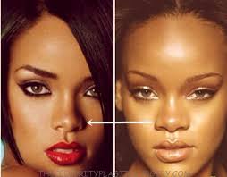 Rihanna Nose Job Gone Wrong Celebrity News Gossips Rumors And Plastic Surgery Stars Days Rhinoplasty Before And After Rhinoplasty Nose Job