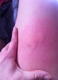 Copaxone® (glatiramer acetate injection) current prescribing information. Copaxone Erfahrung Staublos