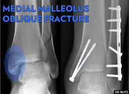 J am acad orthop surg. 5 Kinds Of Medial Malleolus Ankle Fractures