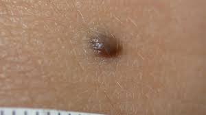 Image result for Blue Nevus