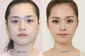 In 2015, a global survey by the international society of aesthetic plastic surgeons placed south korea in the top ten of countries who had the highest rate of . Korean Beauty Standards Another Pressure Point Koreabridge