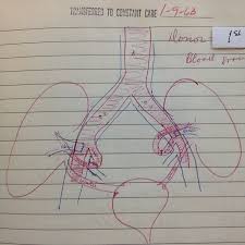 Sketch From The Chart Of Our First Kidney Transplant Patient