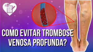 A trombose é um distúrbio circulatório grave causado por um coágulo sanguíneo que bloqueia o fluxo sanguíneo de uma veia (trombose venosa) ou uma artéria (trombose arterial). Trombose Venosa Profunda Causas Sintomas E Tratamento Youtube