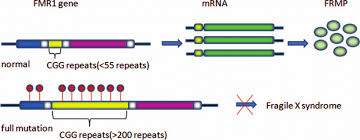 Fragile X Syndrome Causes Symptoms Diagnosis And Treatment Online Biology Notes