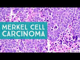 Image result for Merkel Cell Carcinoma