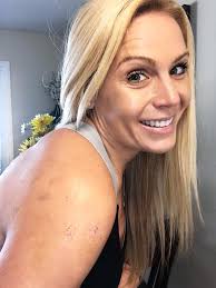 Beach trip planned after injury recovery