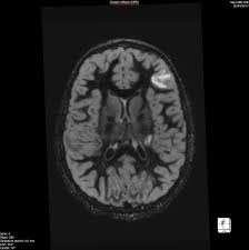 La sclerosi multipla, conosciuta anche come sclerosi a placche, è una malattia cronica demielinizzante di tipo autoimmune, che colpisce cervello e midollo spinale: Un Dubbioso Esordio Di Sclerosi Multipla