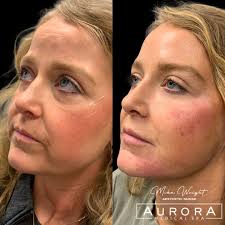 Reveal Your Natural Beauty with Dermal Filler Expertise