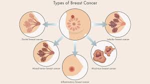 Image result for Inflammatory breast cancer