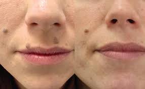 Application of lemons in certain ways on your skin cam help lighten the appearance of beauty marks. Mole Removal From 325 Leeds Bradford Harrogate Skin Surgery Clinic