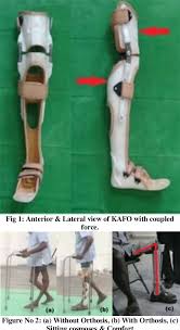 Hyperextended knee injury can occur very frequently in people. Case Report Effectiveness Of An Articulated Knee Hyperextension Orthosis In Genu Recurvatum Semantic Scholar