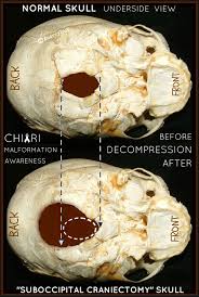Pin On Chiari