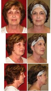 Check spelling or type a new query. Exercise Methods For The Face And Cheeks Get Rid Of Loose Facial Tissue And Sagging Jowls Facial Exercises For Jowls Skin Tightening Stomach Facial Exercises