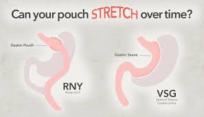 Wls Pouch Bariatric Bariatric Surgery Bariatric Sleeve