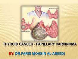 The most common symptom of cancer of the thyroid is a painless lump or swelling that develops in the neck. Thyroid Cancer Papillary Carcinoma