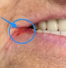 Image result for Angular Stomatitis