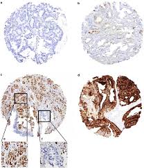 Feeling that you are tired or weak. Cysteine Rich Secretory Protein 3 Overexpression Is Linked To A Subset Of Pten Deleted Erg Fusion Positive Prostate Cancers With Early Biochemical Recurrence Modern Pathology