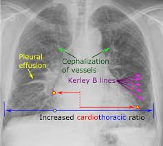 Difference Between Chf Left And Chf Right Difference Between