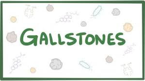 Gallstones Cholelithiasis Practice Essentials Background