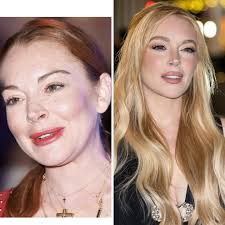 Let's talk about facial balancing 🤍 Lindsey Lohan serves as a well known  example of the impact of working with the wrong injector, as many have  noticed over the years. However, it's