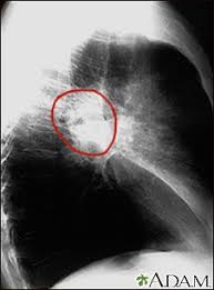 Image result for lung cancer xray