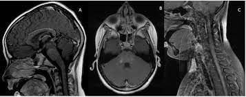 Poyiadji n., noujaim d., stone m., patel s., brent g. References In Chronic Lymphocytic Inflammation With Pontine Perivascular Enhancement Responsive To Steroids Clippers A Pediatric Case Report With Six Year Follow Up Multiple Sclerosis And Related Disorders