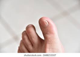 Image result for mykoza nehtů