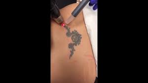 Arizona tattoo removal removing an ex's name💔 🙈👌 ️ come on in people so we can remove your unwanted body art🈵♌️ or bad permanent makeup 🤦🏻‍♀️👁💄👄 #nomoretattoos #erasetattoo #eliminatetattoos #removeex #removebodyart #removal #removepermanentmakeup #goodbyetattoos #oldtown #scottsdaleaz. Procedure Video Phoenix Tattoo Removal Zimmer Cryo Minimize Pain