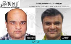 arht global before after hair transplant pictures hair transplant in greece bulgaria and turkey http ww hair transplant before after hair hair loss remedies