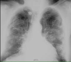 We concluded that asbestos related pleural plaques can under special. Calcified Pleural Plaques On Chest X Ray X Rays Case Studies Ctisus Ct Scanning