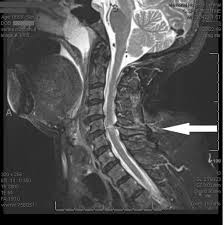 Brown Sequard Syndrome Trauma Surgery Acute Care Open