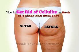 First of all, cellulite is not a disease. How To Get Rid Of Cellulite On Back Of Thighs And Bum Fast At Home