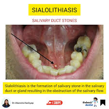 Image result for Sialolithiasis
