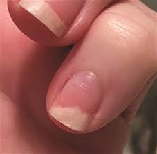 I Injured My Nail Causing It To Lift From The Nail Bed Is The Nail Damaged For Good With Images Nails Nail Bed Damage Damaged Nails