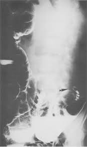 Case Of Colonic Intussusception Secondary To Mobile Cecum Syndrome Repaired  By Laparoscopic Cecopexy Using A Barbed Wound Suture Device