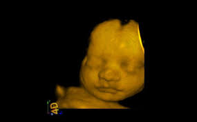 When can you do a 3d ultrasound. Is 3d Baby Ultrasound Safe Things To Know About 3d Ultrasound